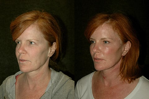 Brow Lift before after Charleston SC