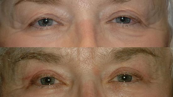 Blepharoplasty before after Charleston SC